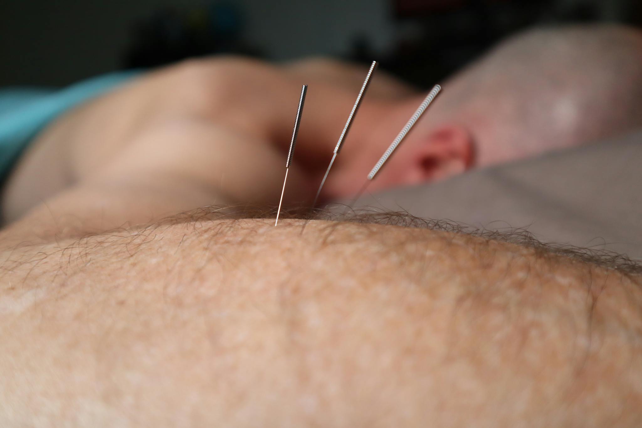 Close-up of acupuncture needles during a therapy session, focusing on skin and relaxation.