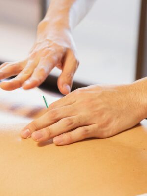 Crop anonymous male doctor putting needles on back during acupuncture therapy session in rehabilitation salon